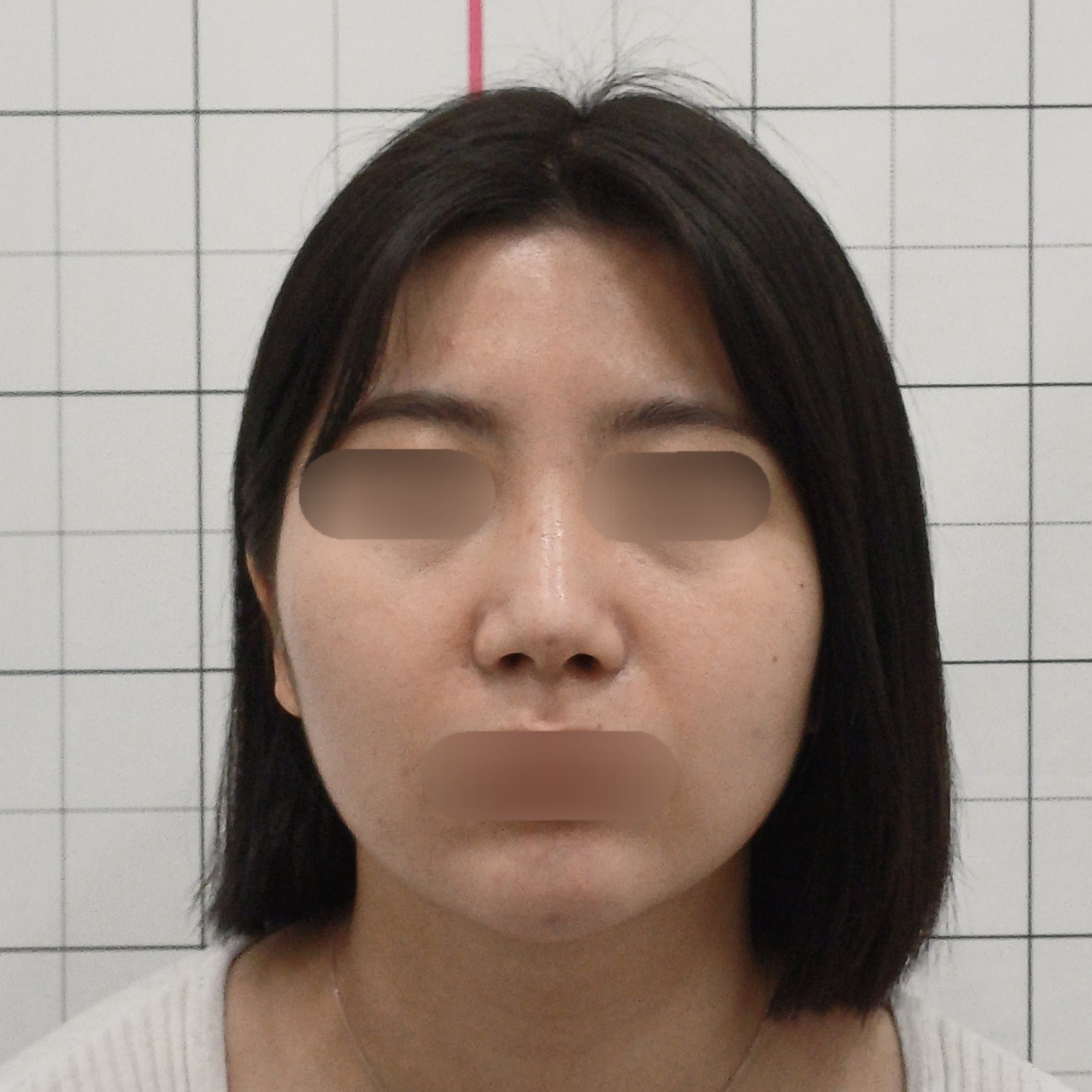 브이라인 리프팅 비포 이미지