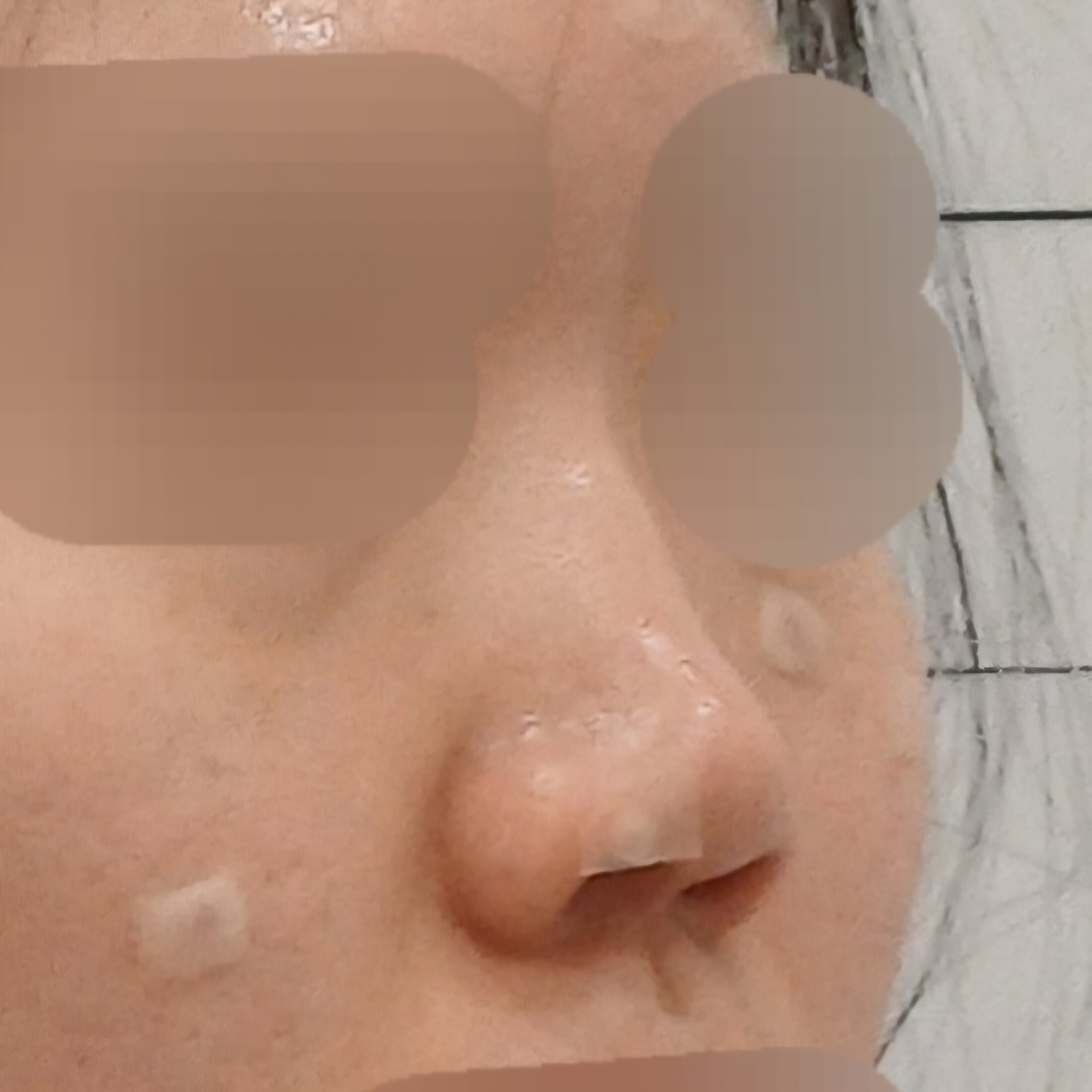 비앙코리프팅 [콧대+코끝] 비포 이미지